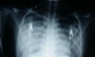 Bé gái mắc bệnh hiếm : 1 triệu người mới có người mắc