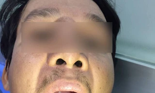 Tưởng cảm sốt thông thường, hóa ra suýt chết vì bạch hầu