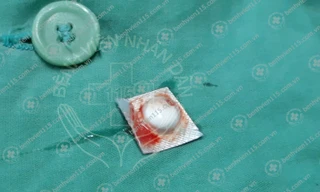 Phát hiện viên thuốc còn vỏ trong phế quản người đàn ông