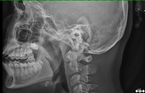 Vừa xem tivi vừa ăn, bé gái phải cấp cứu vì nuốt xương gà