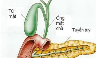 Suýt chết vì hoại tử tụy do bia rượu