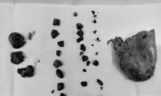 Người đàn ông có túi mật chứa tới gần 50 viên sỏi