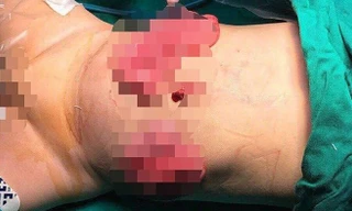 Bé 11 tháng tuổi bị mẹ ruột dùng dao đâm vào bụng