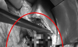 Cứu sống nam thanh niên đứt lìa gan vì tai nạn giao thông