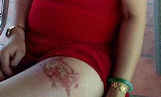 Điện thoại phát nổ, một phụ nữ bị bỏng đùi