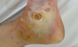 Hoại tử chân vì “chữa mẹo” vết phỏng pô xe