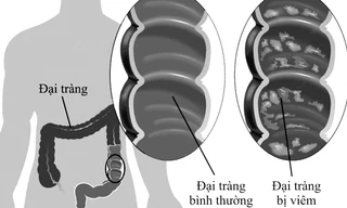 Mô phỏng đại tràng bình thường và đại tràng bị viêm