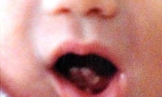 Bé gái mới sinh có hai răng cửa