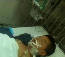 Ngã từ lan can, bé trai 6 tuổi vỡ lá lách