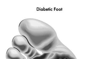 Bàn chân biến chứng tiểu đường