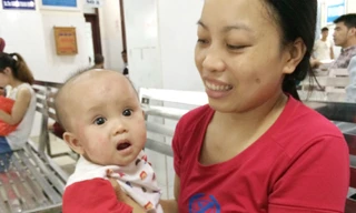  Bệnh nhi Khánh Vy bị viêm da cơ địa. Ảnh T.Hà