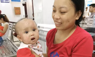  Bệnh nhi Khánh Vy bị viêm da cơ địa. Ảnh T.Hà