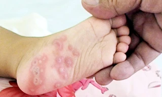 Biểu hiện nốt phỏng ở lòng bàn chân trong bệnh tay chân miệng 