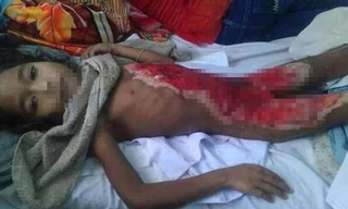 Rahlan Méo trong tình trạng bị phỏng rất nặng. Ảnh: L.N