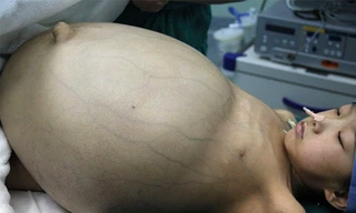 Khối u có kích thước lớn hơn hai quả bóng đá và nặng gần 15 kg. Ảnh: Getty Images.