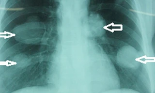 Kinh hãi hàng nghìn sán chó ở phổi bệnh nhân