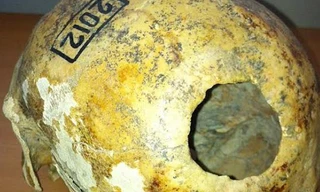 Kỳ lạ ca phẫu thuật hộp sọ cách đây 2.300 năm