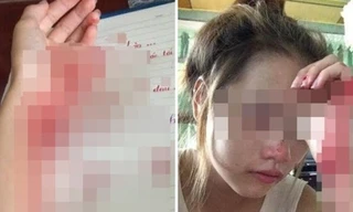 Hình ảnh bàn tay đầy máu và khuôn mặt thảm thương của P.K.M.