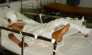 Bỏng thường để lại các di chứng ảnh hưởng đến cuộc sống của trẻ về sau. Ảnh minh họa: Thiên Chương