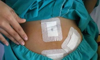 Hướng dẫn mổ qua điện thoại cho lính đảo bị đau ruột thừa 