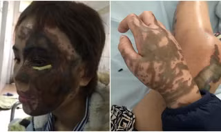 Thiếu úy công an tạt axit vào mặt vợ sắp cưới lĩnh 6 năm tù