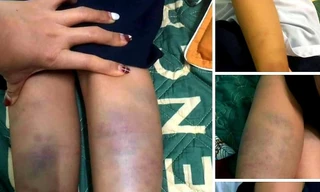 Tá hỏa vì con bị đánh bầm tím, mẹ bức xúc khi nghe cô giáo trả lời