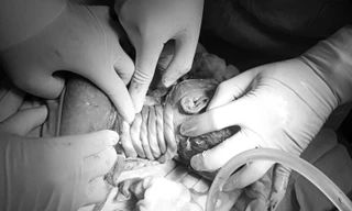 Thai nhi 34 tuần bị dây rốn quấn đến 6 vòng quanh cổ