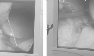 Vì sao 3 bệnh nhi ở Hải Phòng bị thủng dạ dày khi mắc COVID-19?