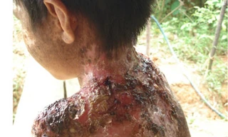 Sự thật những đứa trẻ bị 'quỷ ám' ở Hòa Bình