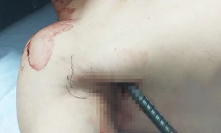 Cứu nam thanh niên bị 2 thanh sắt xuyên qua người 