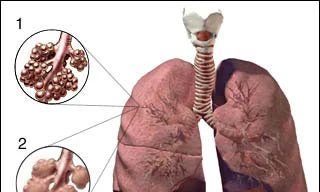 Người cao tuổi ho kéo dài, bệnh gì?