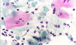 Trị viêm âm đạo do Trichomonas