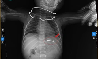 Đinh vít sắt dài 5cm trong dạ dày bé trai 15 tháng tuổi