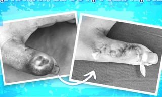 Đắp thuốc lá của thầy lang để chữa nhọt, bé trai suýt mất ngón tay