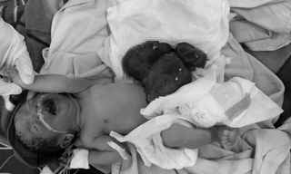 Cứu sống bé sơ sinh bị dị tật nội tạng ngoài ổ bụng