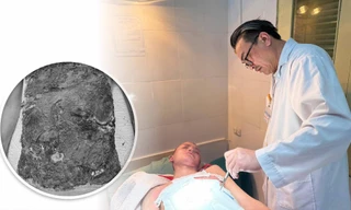 Nhiễm trùng hoại tử hết vùng bụng vì bỏ viện về nhà chữa bỏng bằng thuốc nam