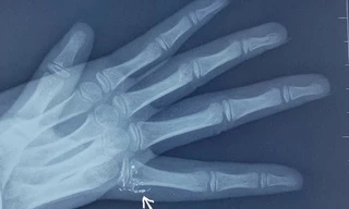 Nhiễm độc thủy ngân sẽ hại thận, phổi, não và hệ thần kinh