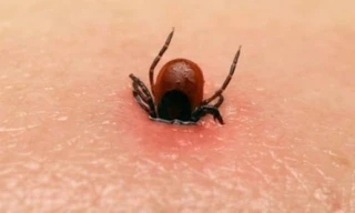 Bác sỹ cảnh báo vết đốt nhỏ từ côn trùng cũng có thể gây chết người