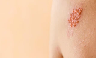 Bệnh Zona thần kinh đang ngày càng trẻ hóa, dễ bị nhầm với tai biến