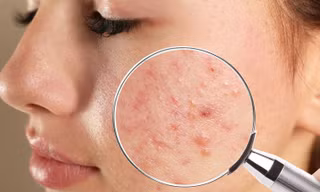 Muốn trị mụn tận gốc phải hiểu đúng về từng loại mụn