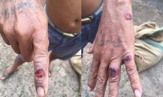 Bệnh than bùng phát mạnh nhất trong 10 năm, nguy cơ lây lan rất cao