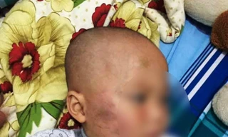 Bảo mẫu tát trẻ sưng mặt ở Vĩnh Long: Không có sự thỏa thuận nào 