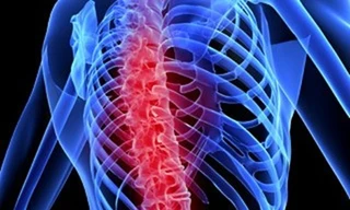 Ghép tủy sống chữa… khuyết tật tứ chi và các bệnh tâm thần!