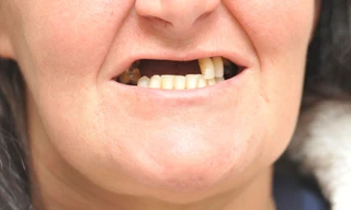 Người phụ nữ bay mất nửa hàm răng vì ham rẻ