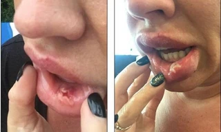Mặt biến dạng, môi thủng lỗ chỗ vì... nghiện tiêm botox 