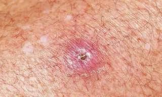 Sự bùng phát ổ dịch ăn thịt ở Úc, loét Buruli.