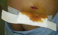 Bà Tý với vết thương do đạn bắn phía sau lưng.