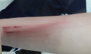 Cô bé 12 tuổi bị cha đánh phải nhập viện vì... 'ham chơi'