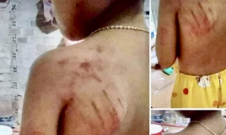 Học sinh tiếp thu bài chậm, bị giáo viên đánh bầm vai