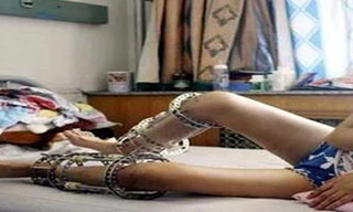 Suýt tàn phế vì mong thành ‘chân dài’